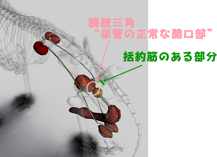 異所性尿管