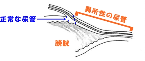 異所性尿管