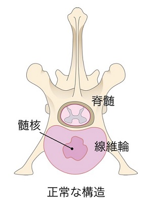 胸腰部椎間板ヘルニア