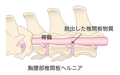 胸腰部椎間板ヘルニア