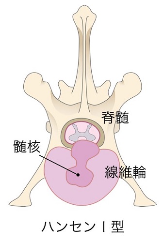 胸腰部椎間板ヘルニア