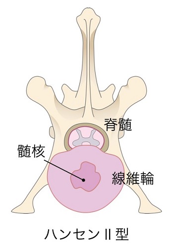 胸腰部椎間板ヘルニア