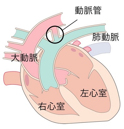 動脈管開存症