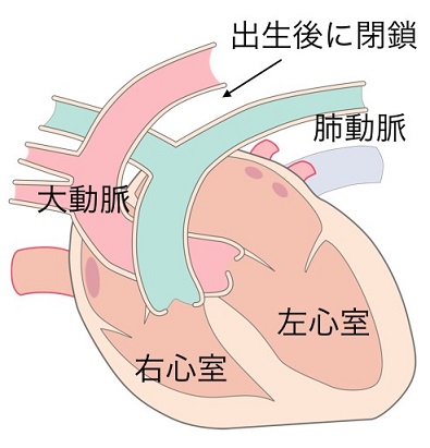 動脈管開存症