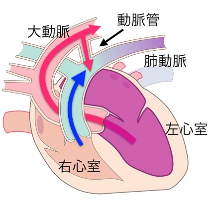 動脈管開存症