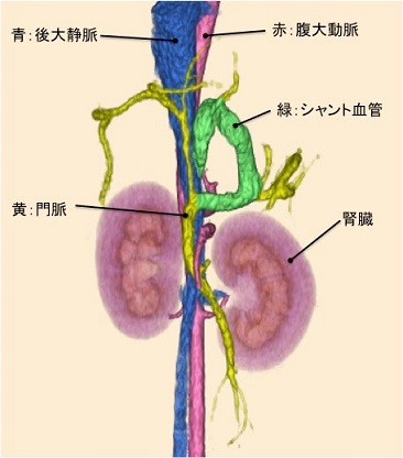 門脈体循環シャント